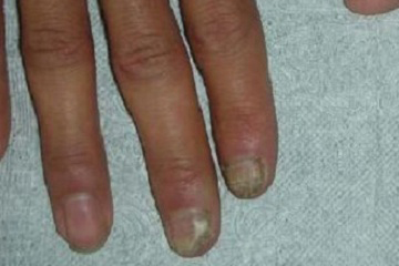 太原患者脚上灰指甲是怎么引起的，灰指甲怎么办